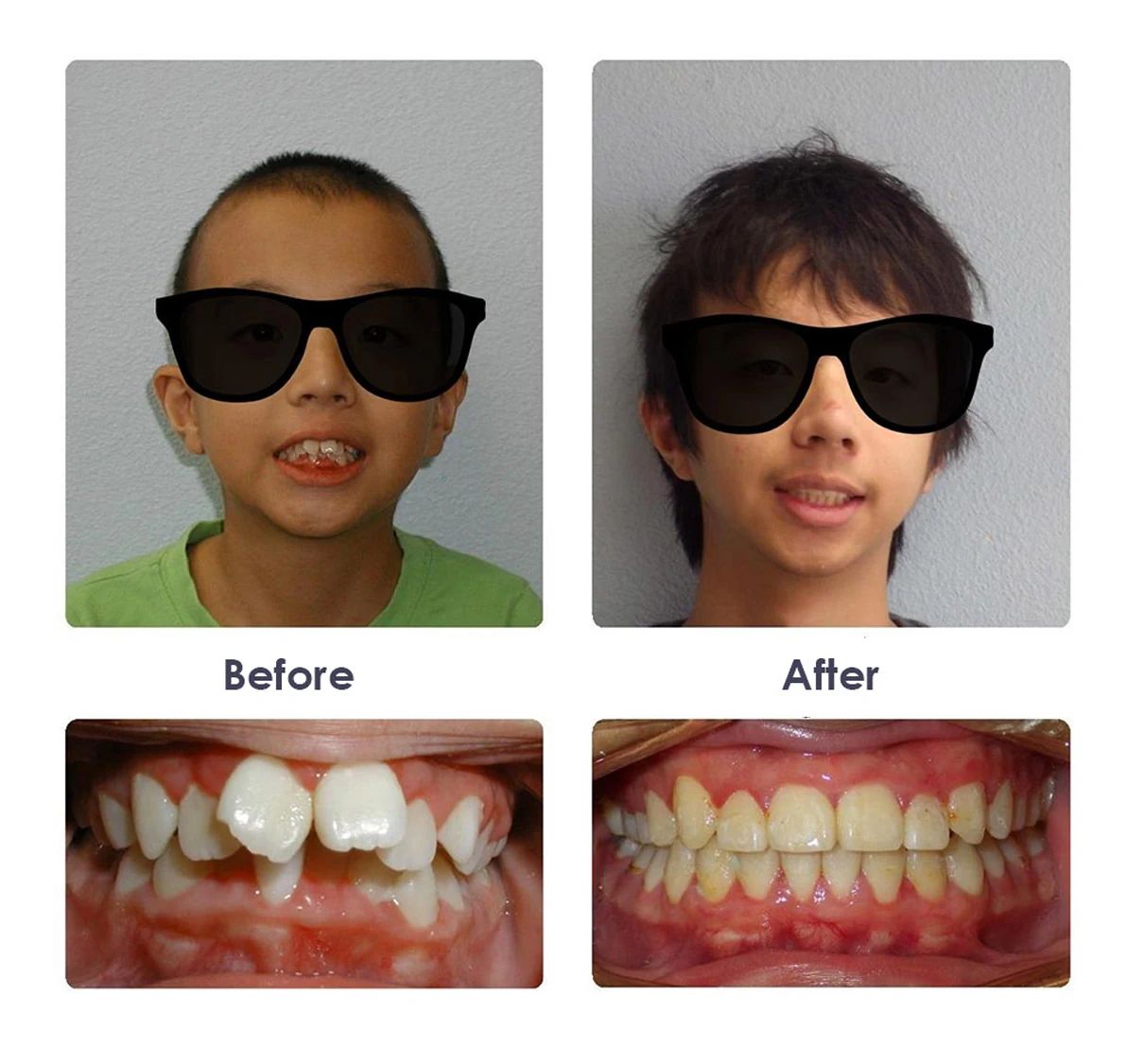 Before and after orthodontic treatment, case 1