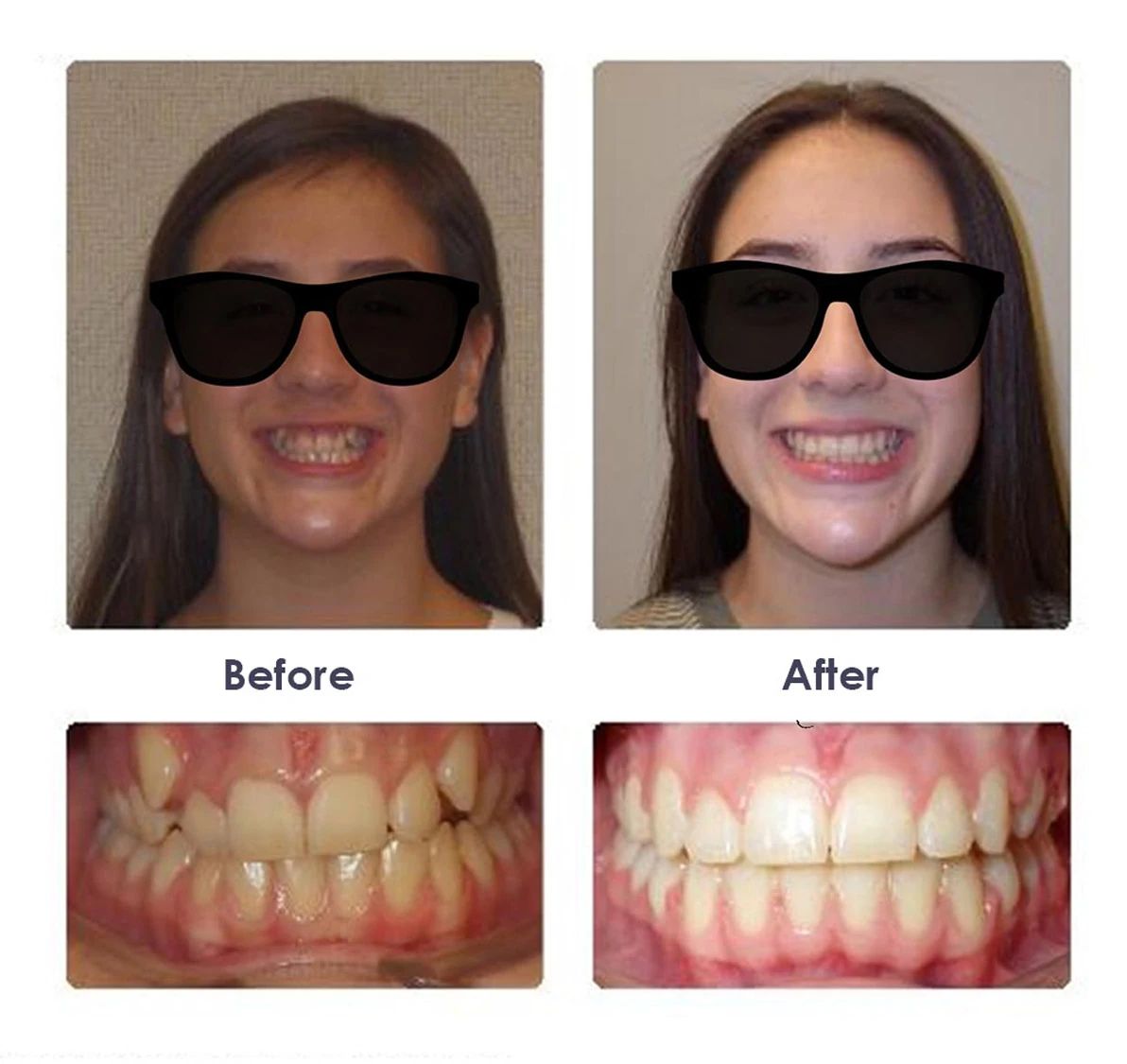Before and after orthodontic treatment, case 2
