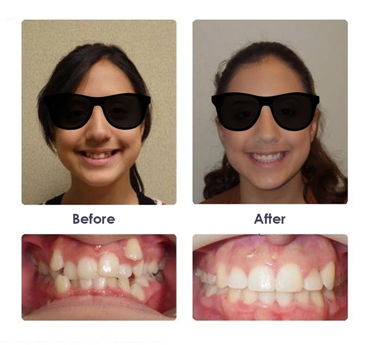 Before and after orthodontic treatment, case 3