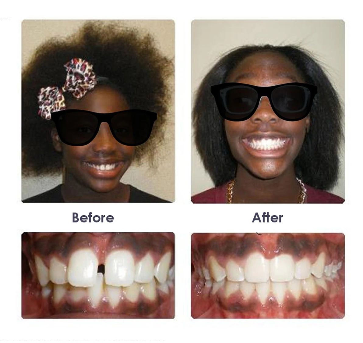 Before and after orthodontic treatment, case 4