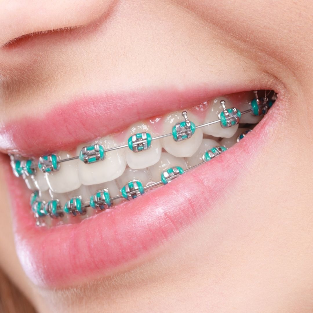 Lingual Braces
