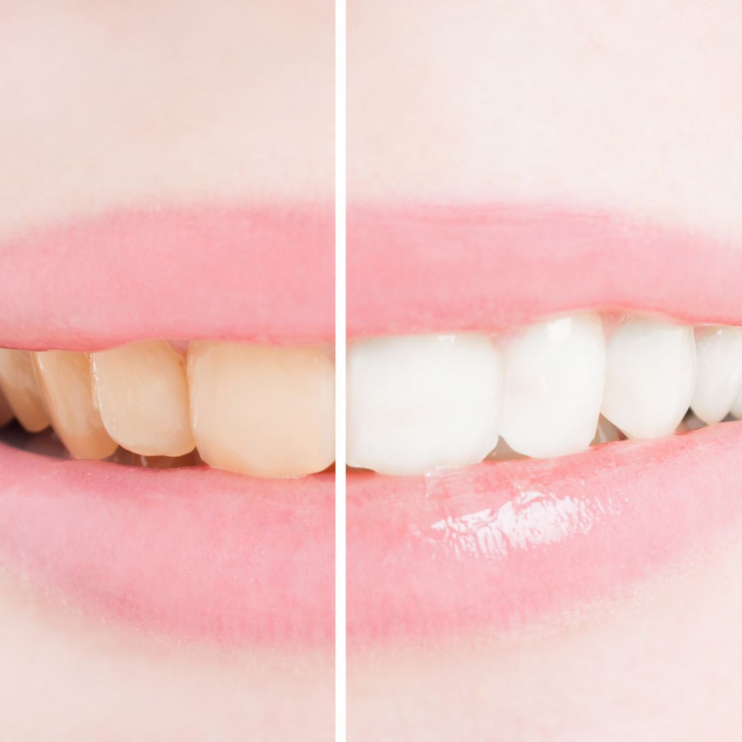 best way to whiten your teeth